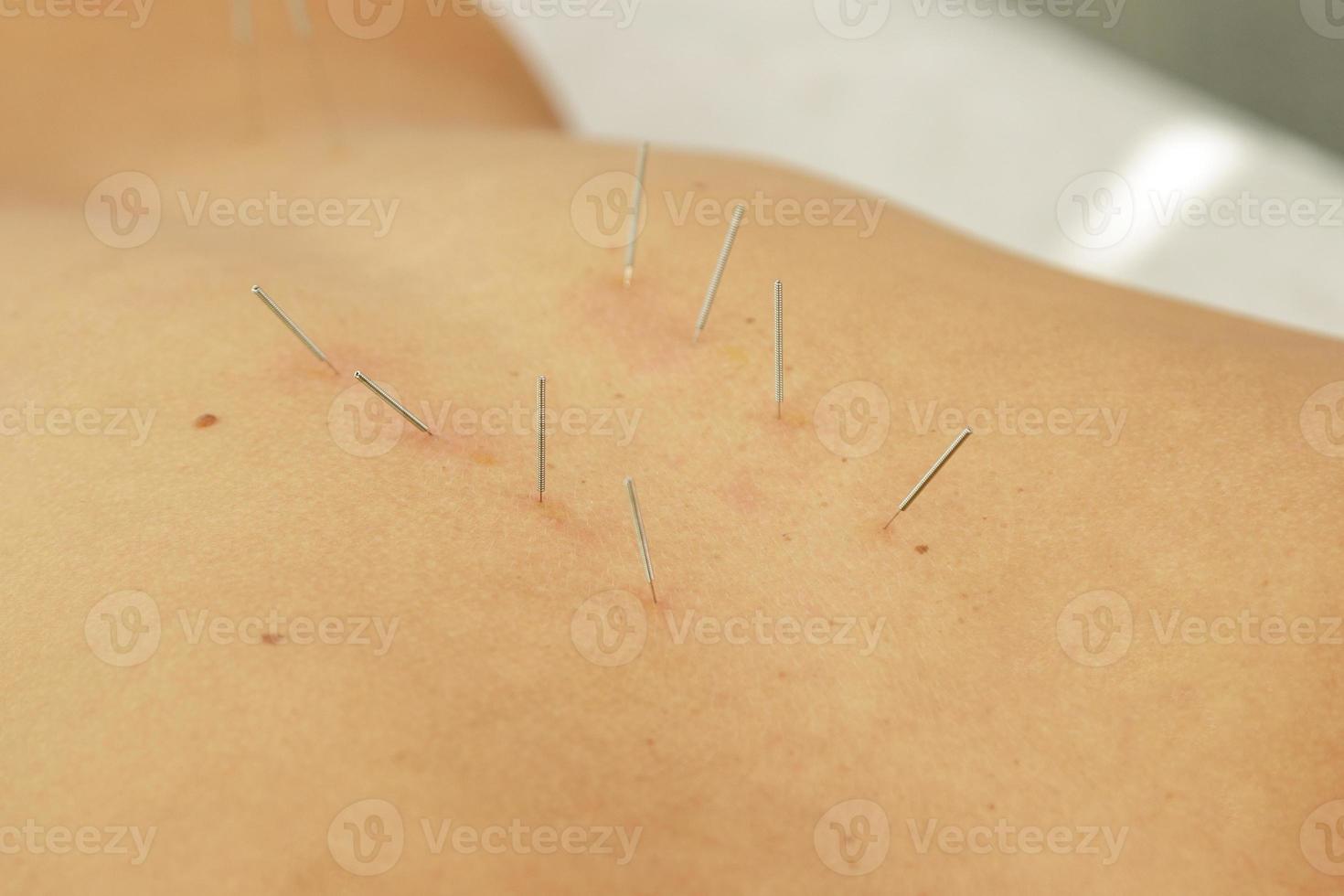 Female back with steel needles during procedure of acupuncture therapy photo