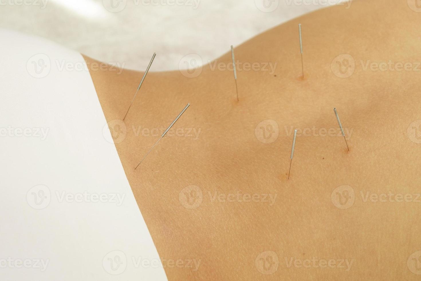 Female back with steel needles during procedure of acupuncture therapy photo