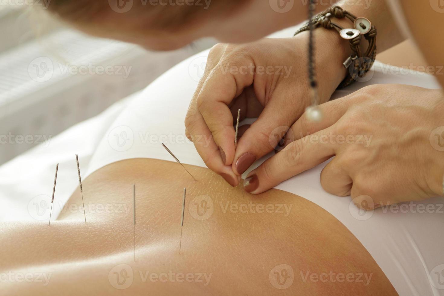 maestro está inyectando agujas de acero durante el procedimiento de terapia de acupuntura foto
