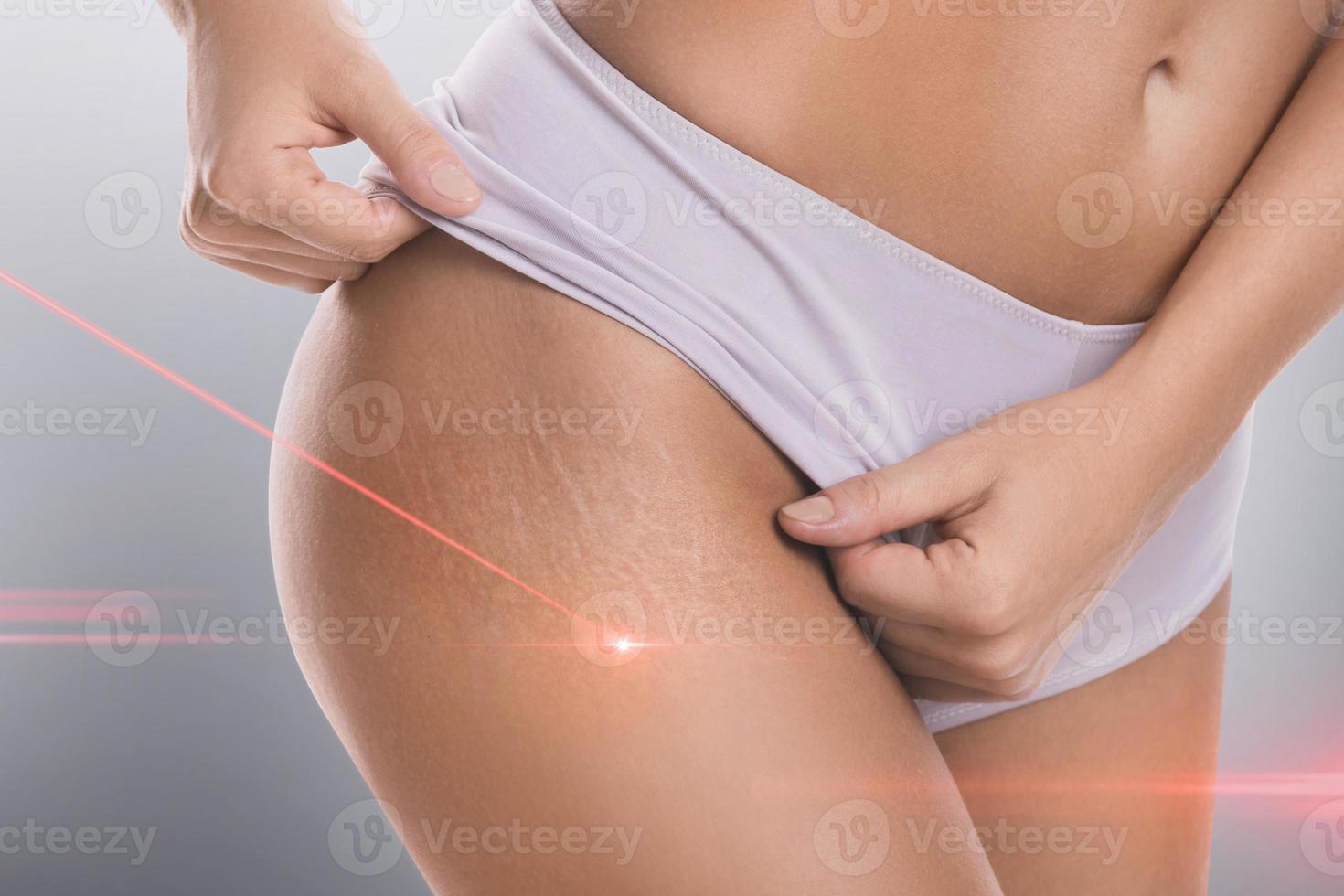 Stretch marks during laser removal session treatment photo