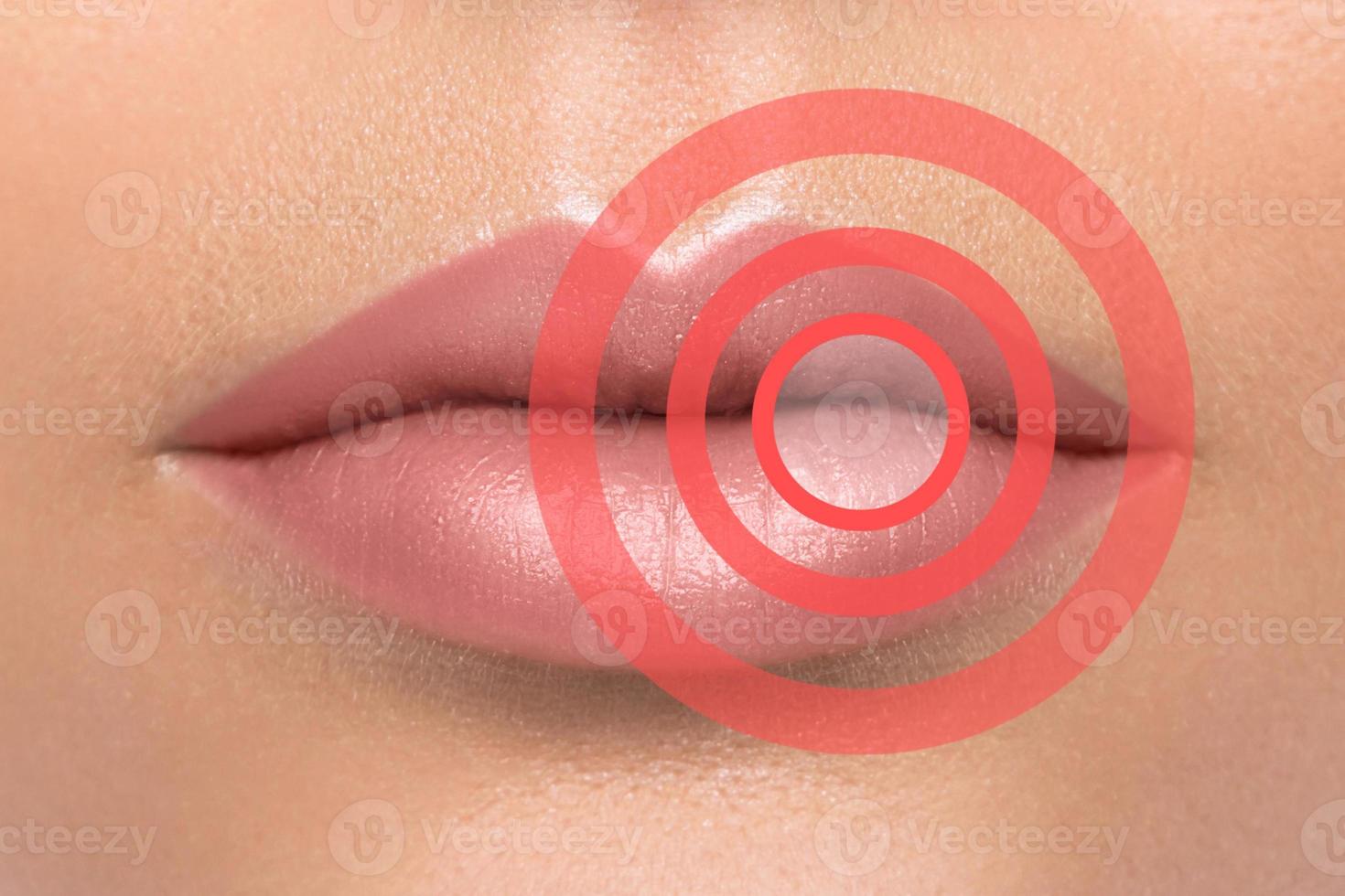 labios con círculos rojos. área afectada o problemática. concepto de salud o belleza. foto