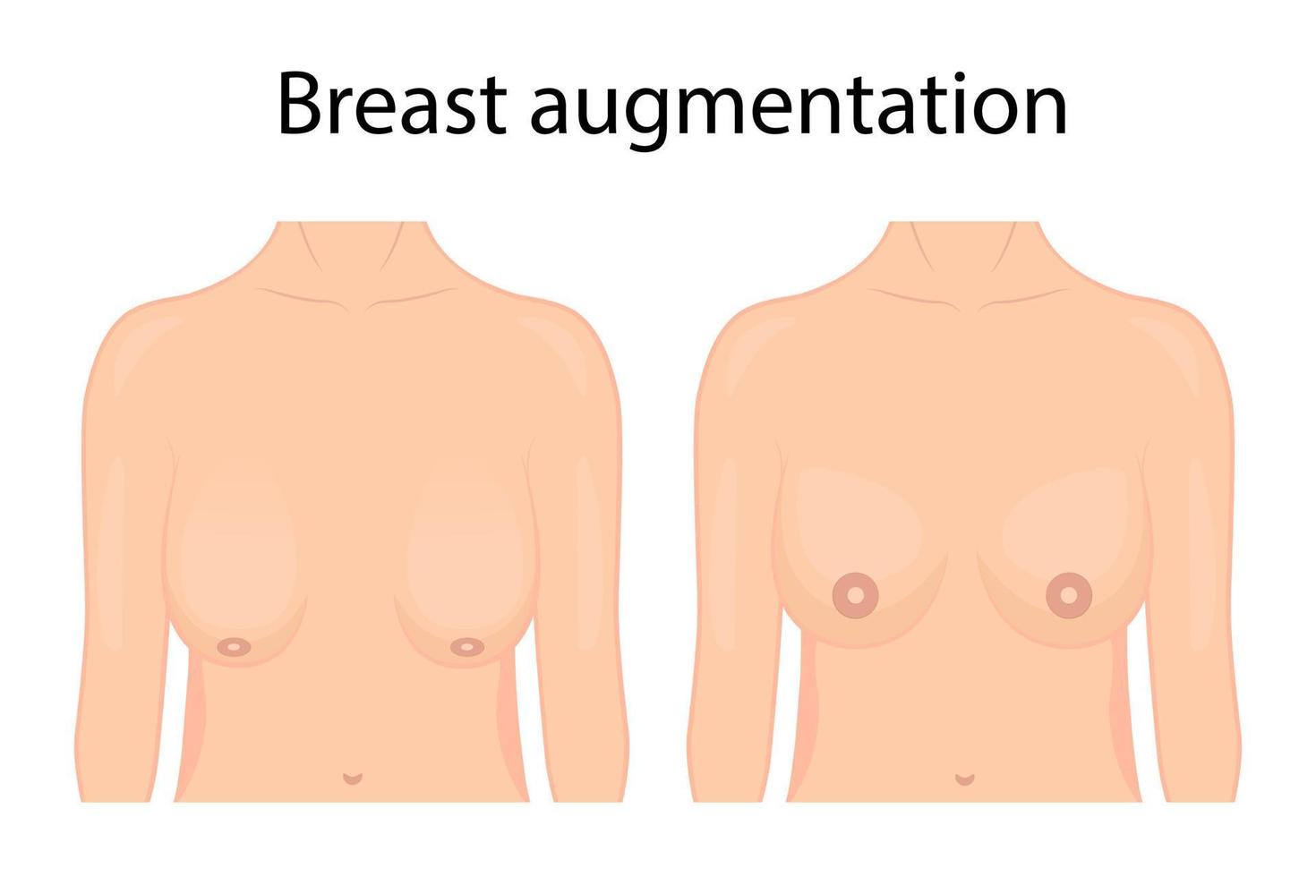 Vector illustration of breast plastic surgery. before and after. For advertising and economic publications