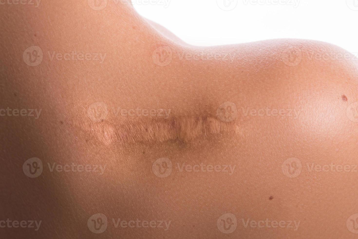 Woman with a scar on her shoulder photo