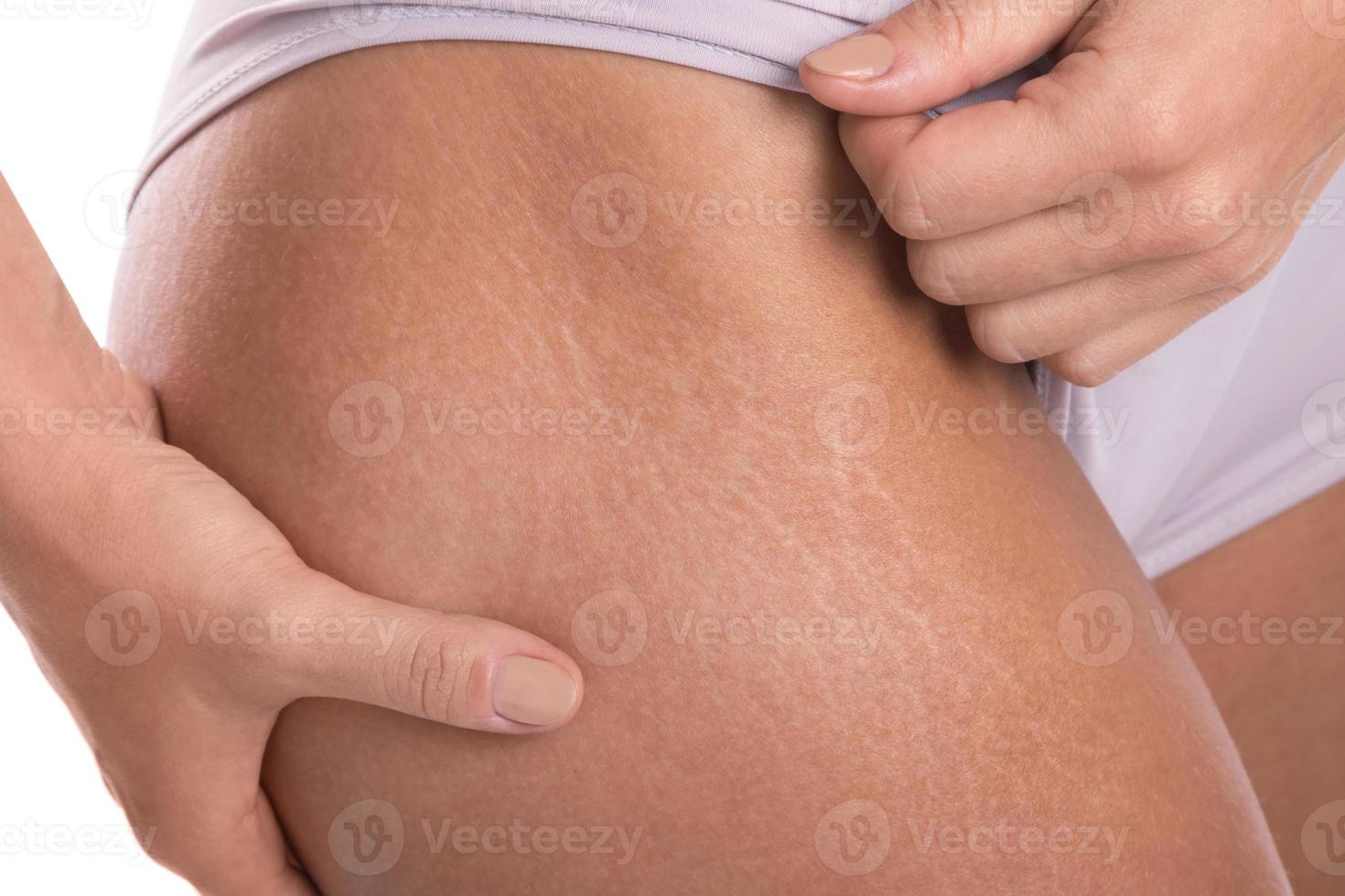 Closeup of female hips with a stretch marks photo