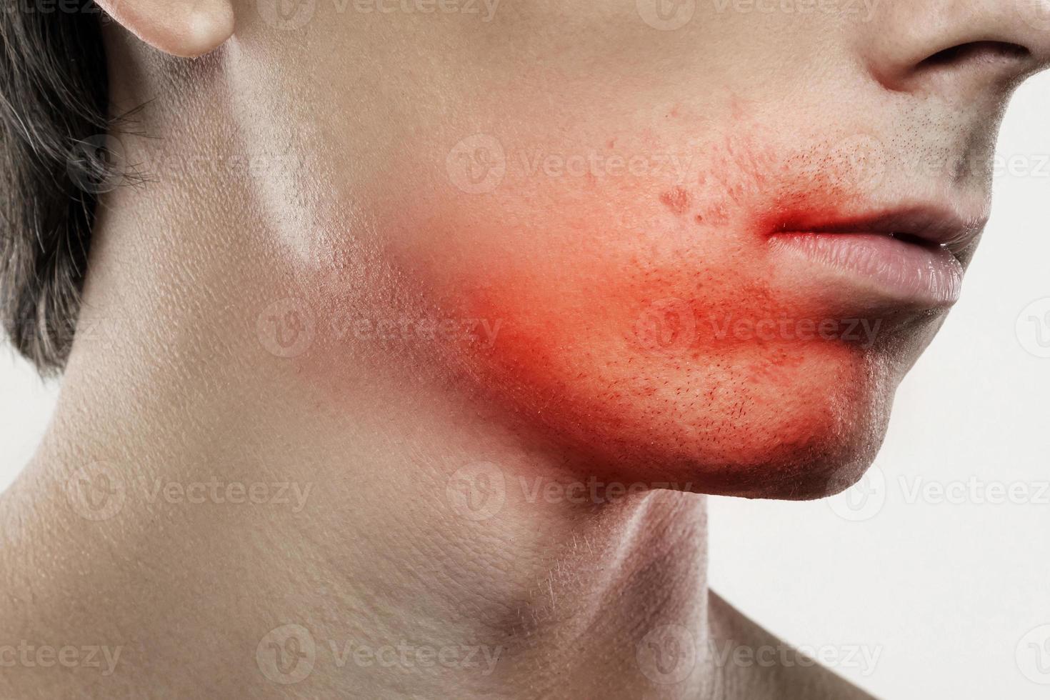 irritación de la piel sensible después de una rutina de afeitado foto