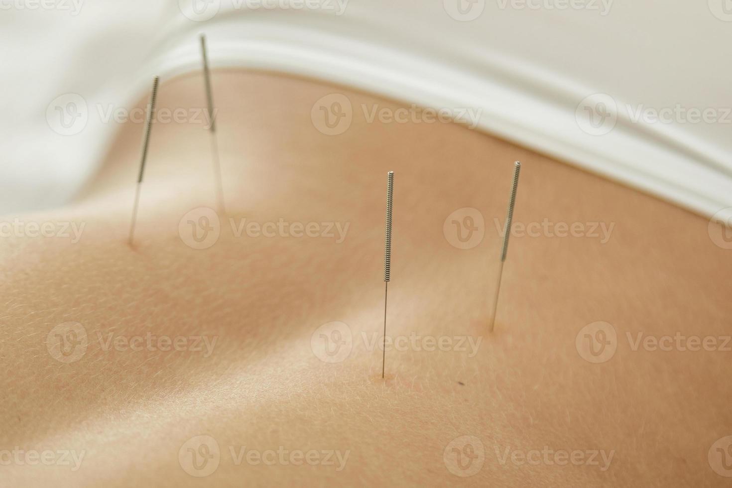 espalda femenina con agujas de acero durante el procedimiento de terapia de acupuntura foto
