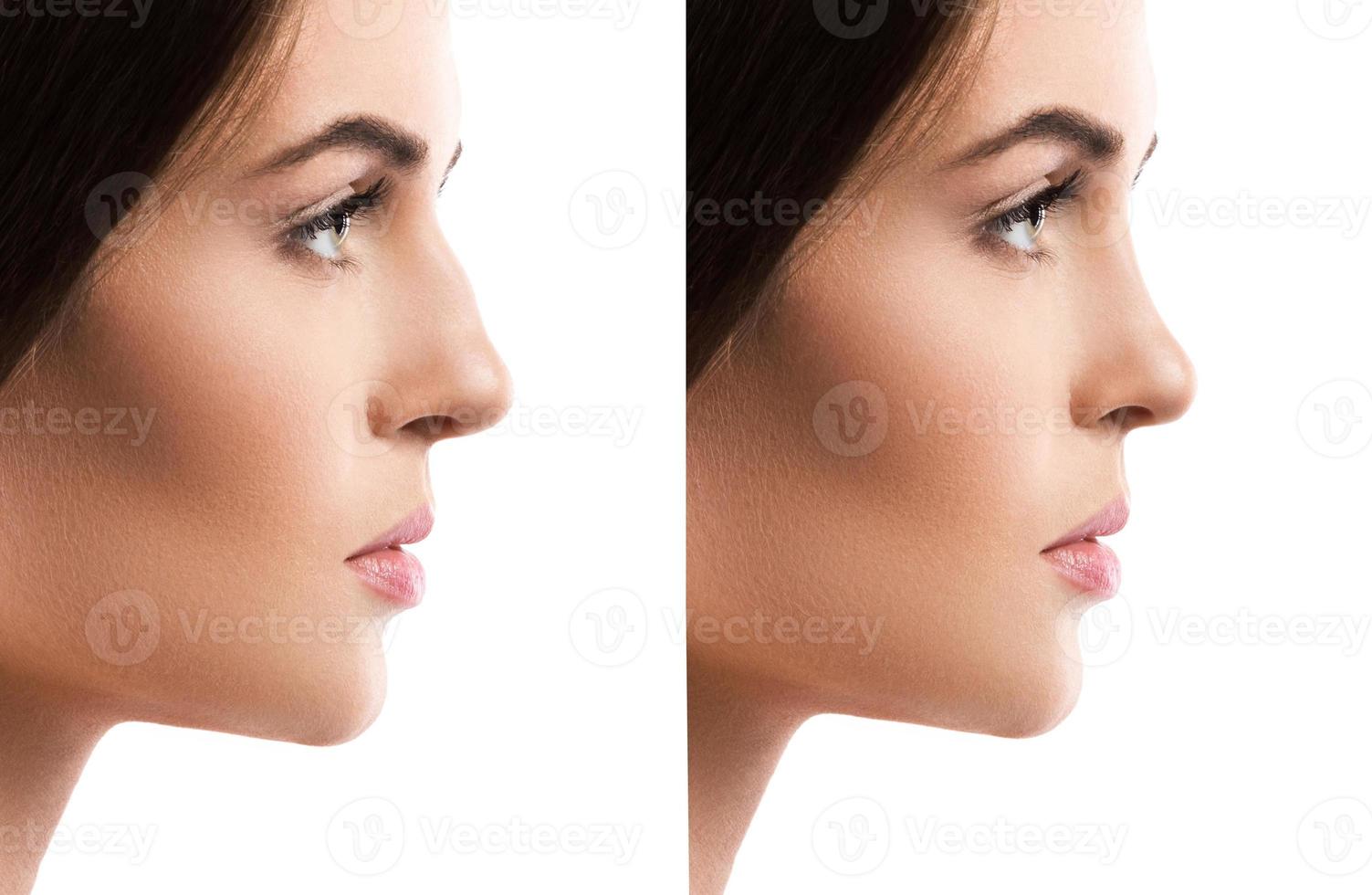 comparación del rostro femenino después de la rinoplastia foto