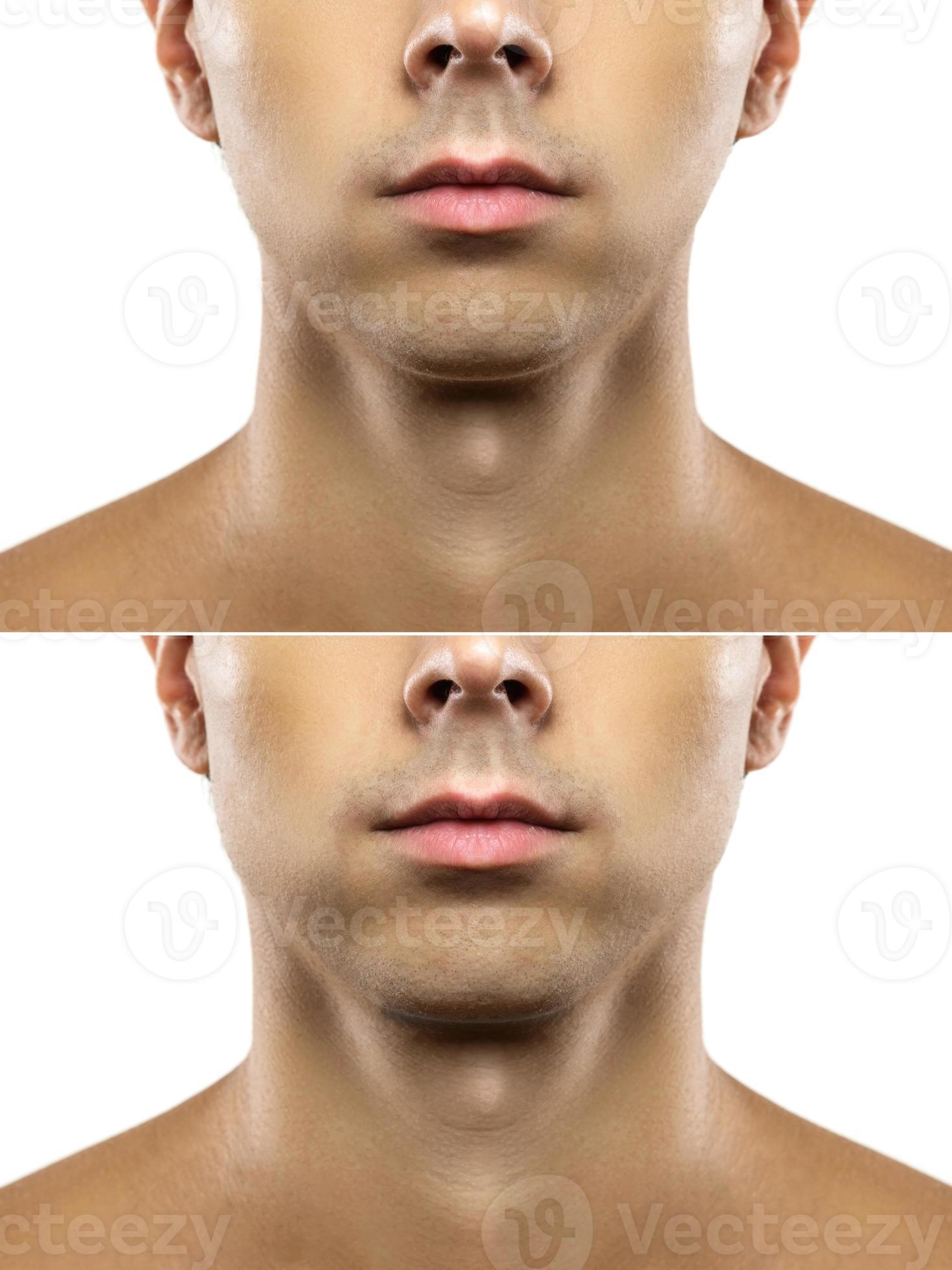 Surgery or mewing exercises. Result of a jawline reshape. 16235513 Stock  Photo at Vecteezy