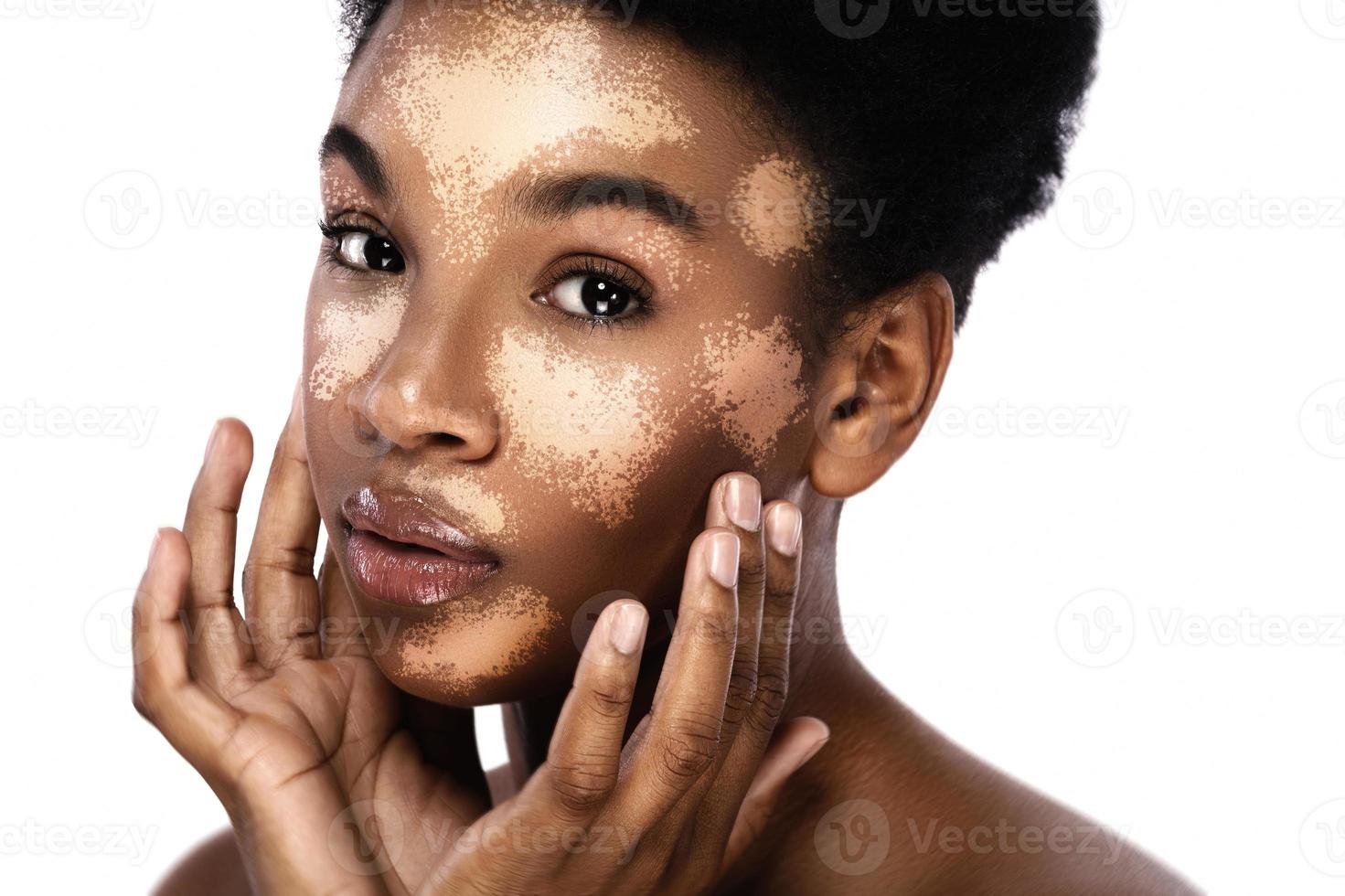 Beautiful black woman with vitiligo skin disorder photo