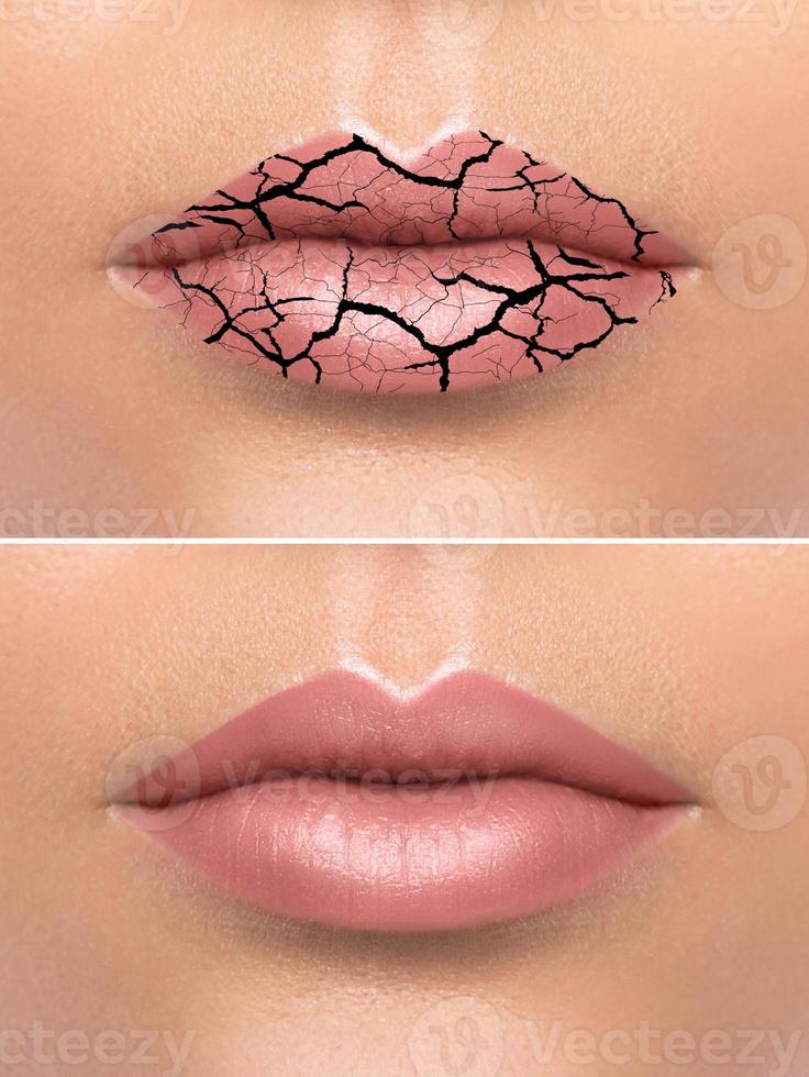 Chapped female lips after treatment photo