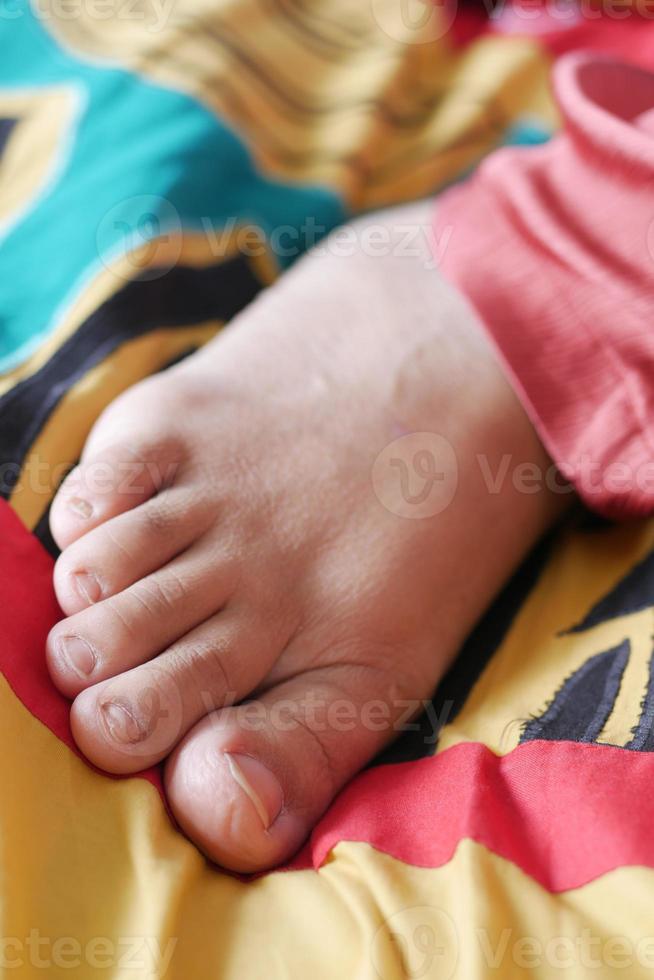 close up of women's infected feet fingers on bed , photo