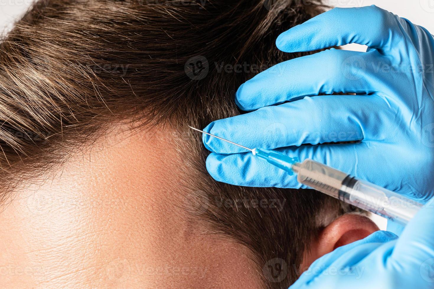 hombre que recibe una inyección en el cuero cabelludo para que crezca el cabello foto