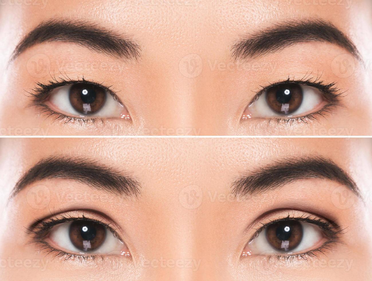 East Asian blepharoplasty or double eyelid surgery photo