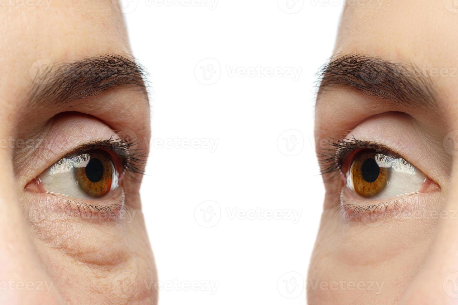 Anti aging treatment. Female eyes after rejuvenation. photo