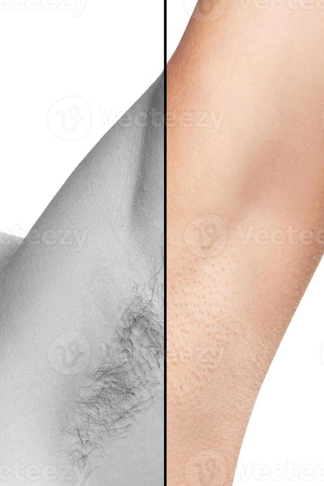 Comparison of female armpit after hair removal photo