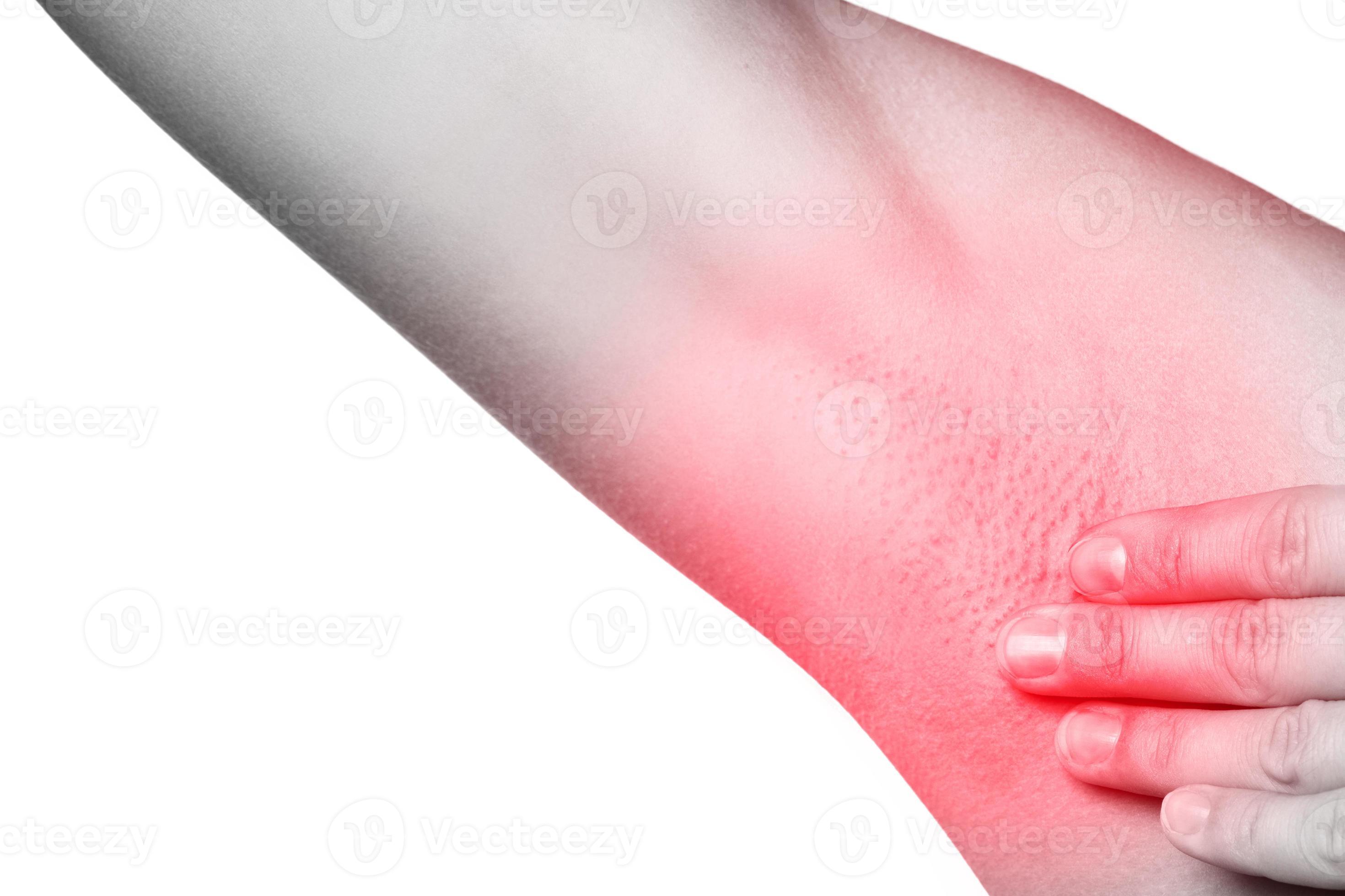 Female armpit with redness. Skin irritation or swollen lymph node