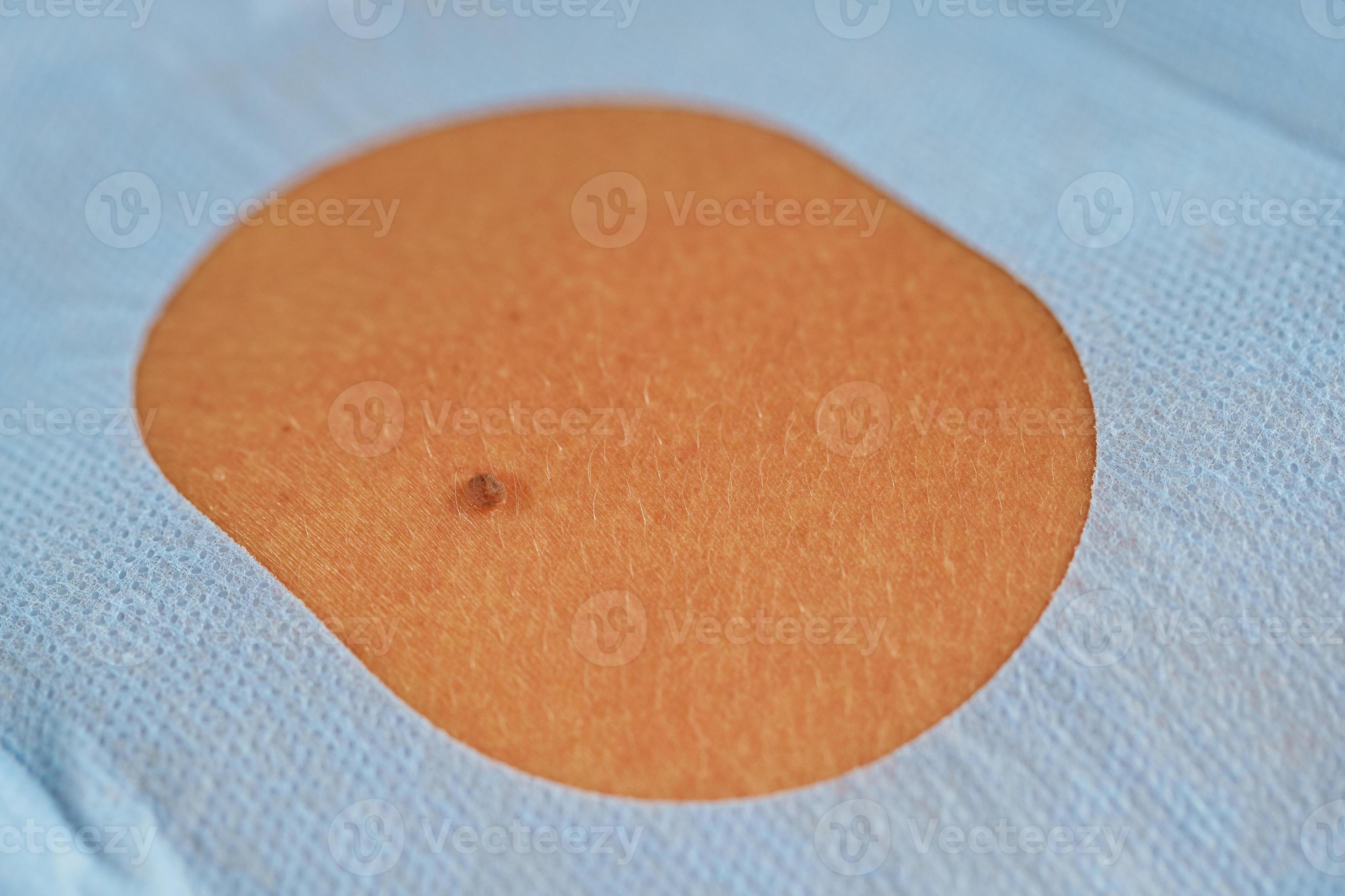 Birthmark Removal Dermatologic Surgery 16252604 Stock Photo At Vecteezy