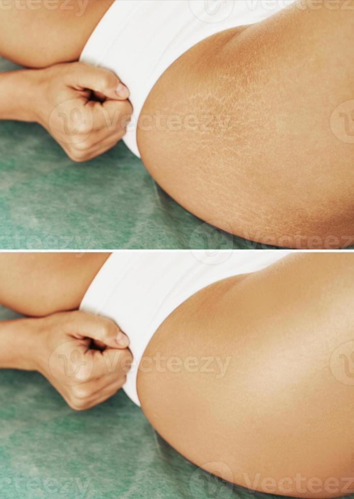 Female hip with comparison before and after stretch marks treatment photo