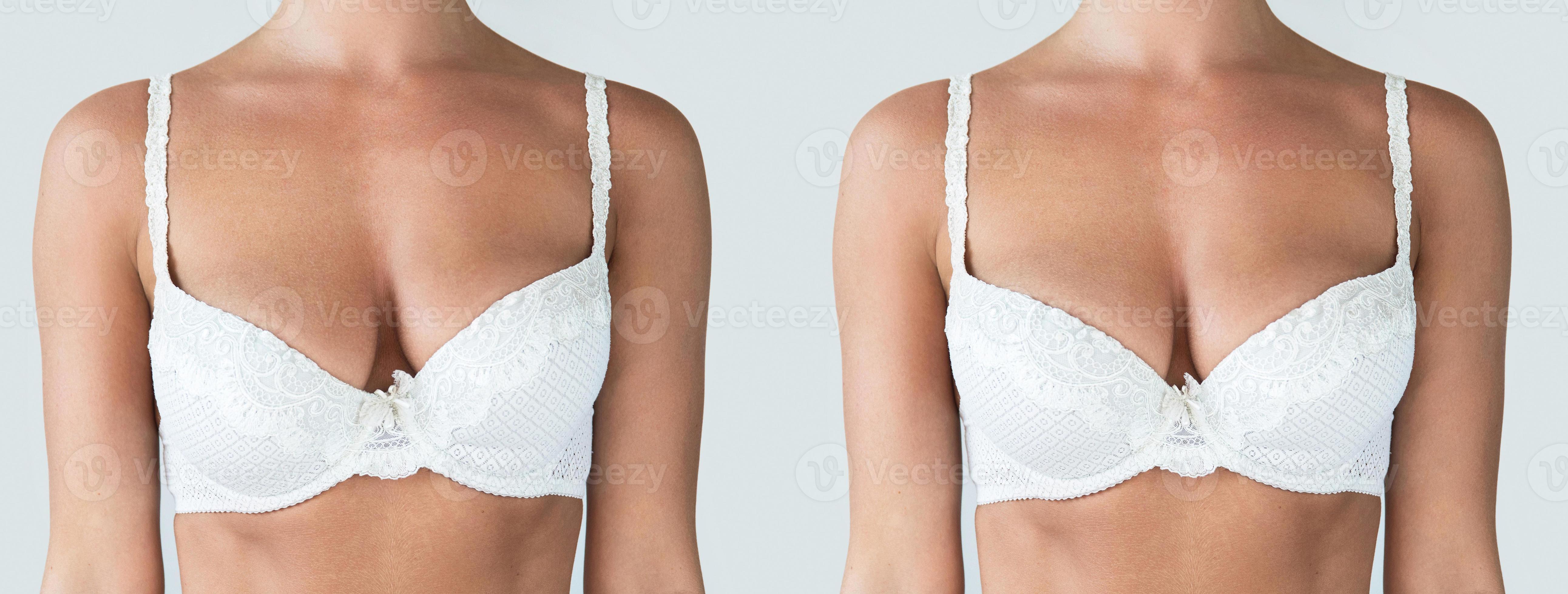 Learn About Breast Asymmetry Correction