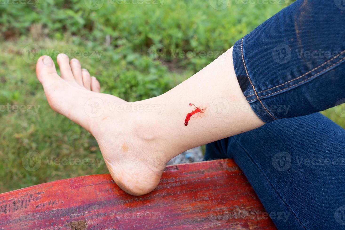 woman-bleed-at-leg-from-leech-after-trekking-in-forest-16263377-stock