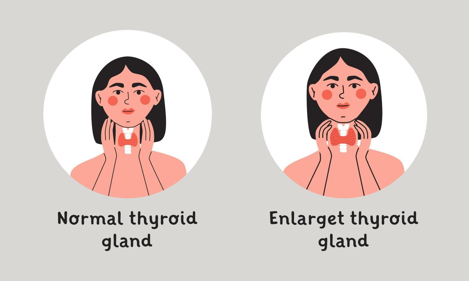 Normal and enlarget thyroid gland. Woman showing thyroid gland on her neck. Endocrinology system symbol, organ responsible for hormone production. vector