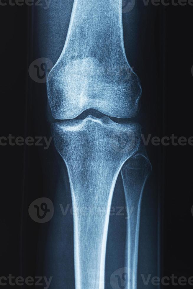 imagen de rayos x de la rodilla humana foto