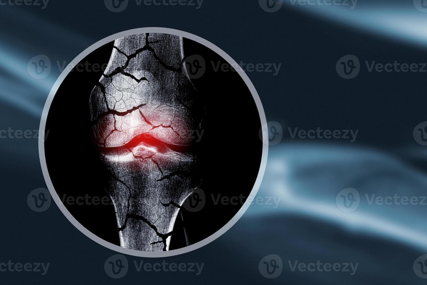 Concept of Osteoporosis X-ray image with cracked bones photo