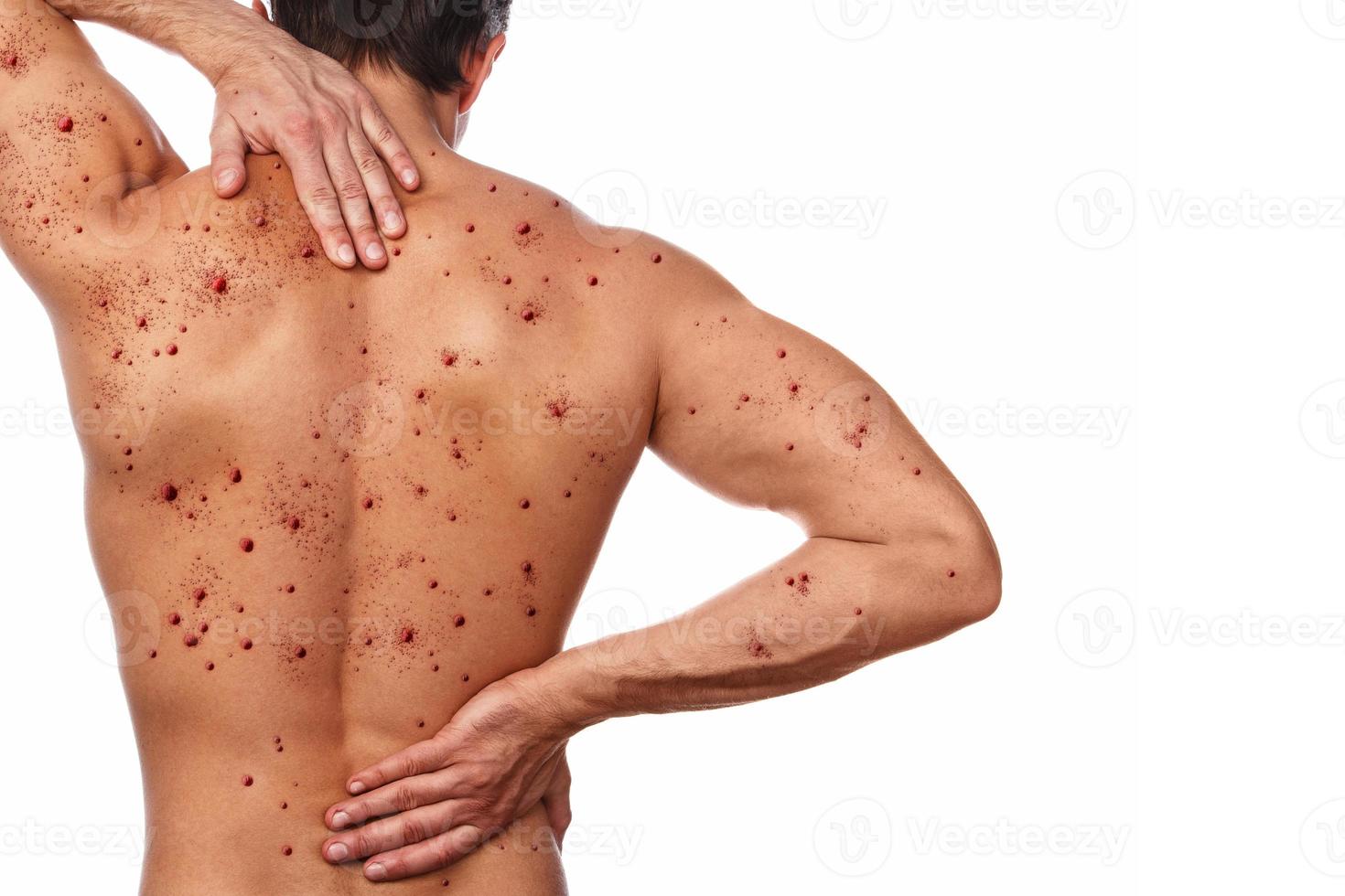 Male back affected by blistering rash because of monkeypox or other viral infection photo