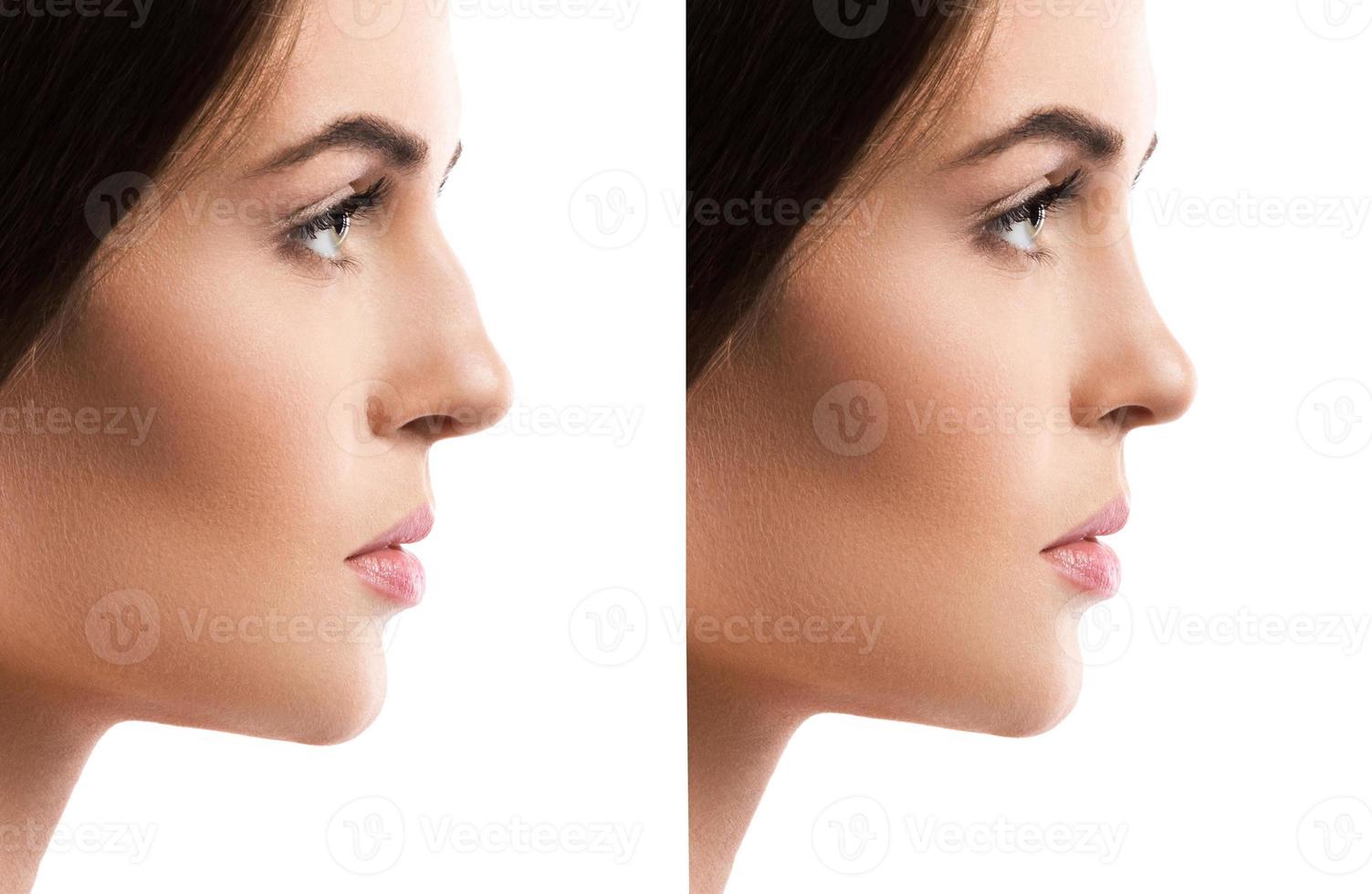 Comparison female face after rhinoplasty on white background photo