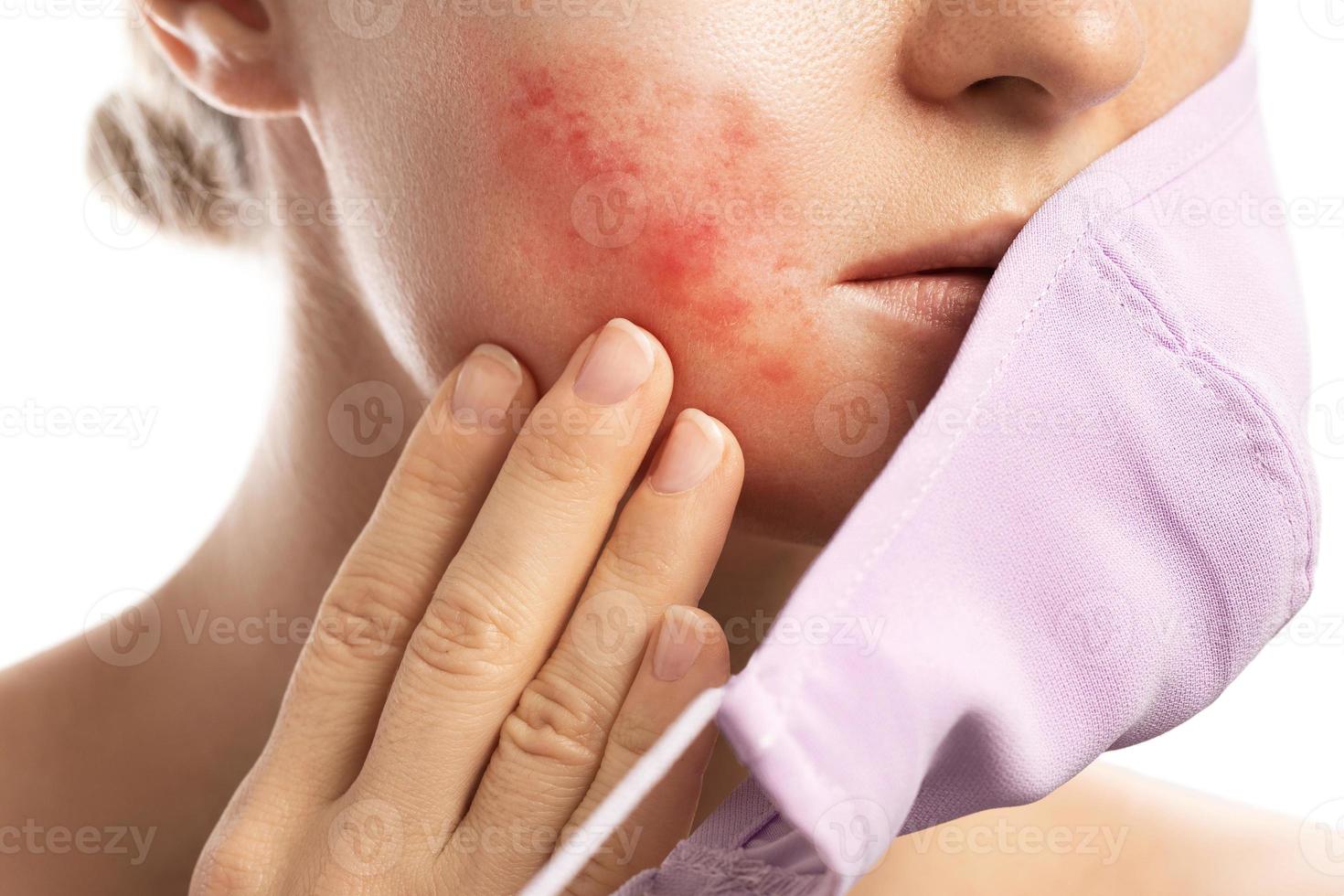 maskne - brotes de acné por usar una máscara facial foto