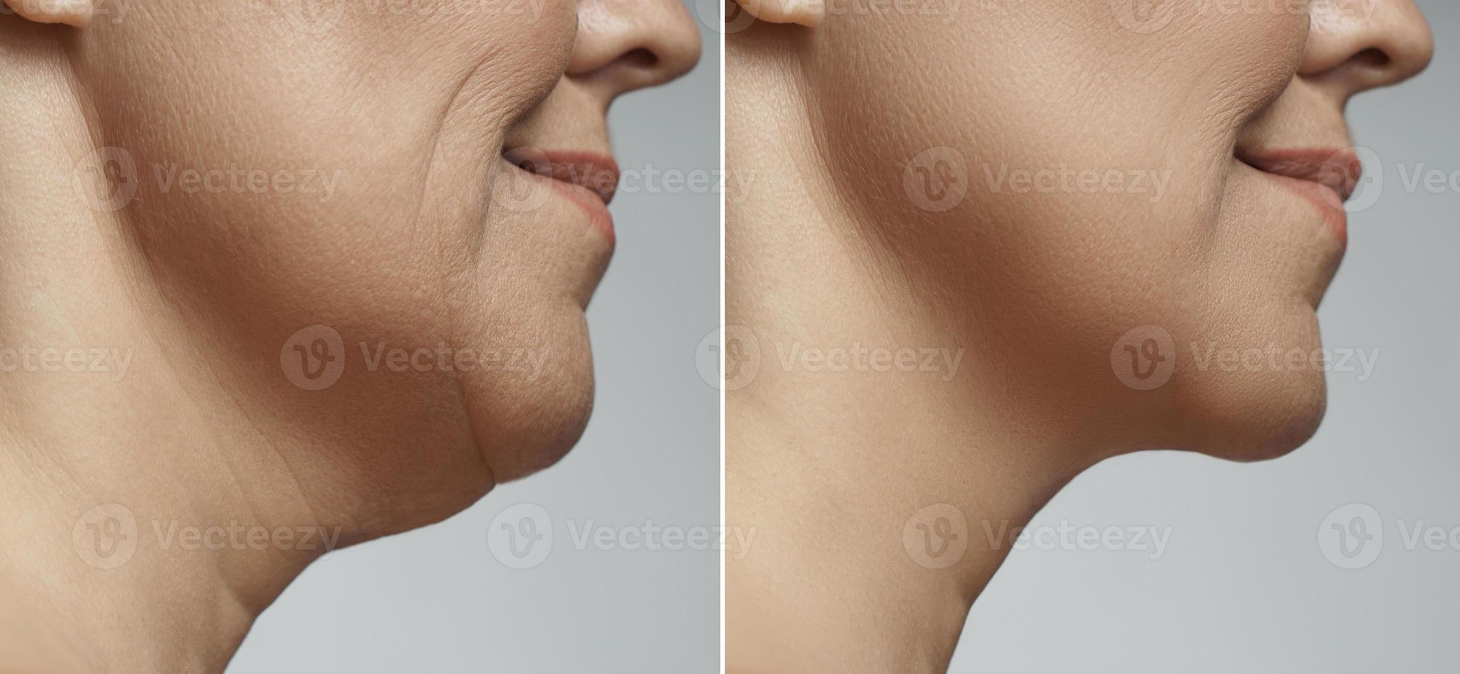 Mewing Exercises. Result of a Jawline Reshape Stock Photo - Image