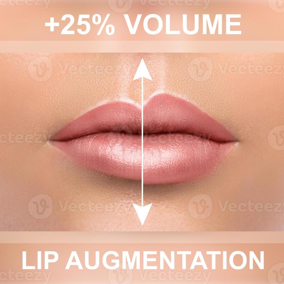 Comparison of female lips after augmentation with filler injections photo