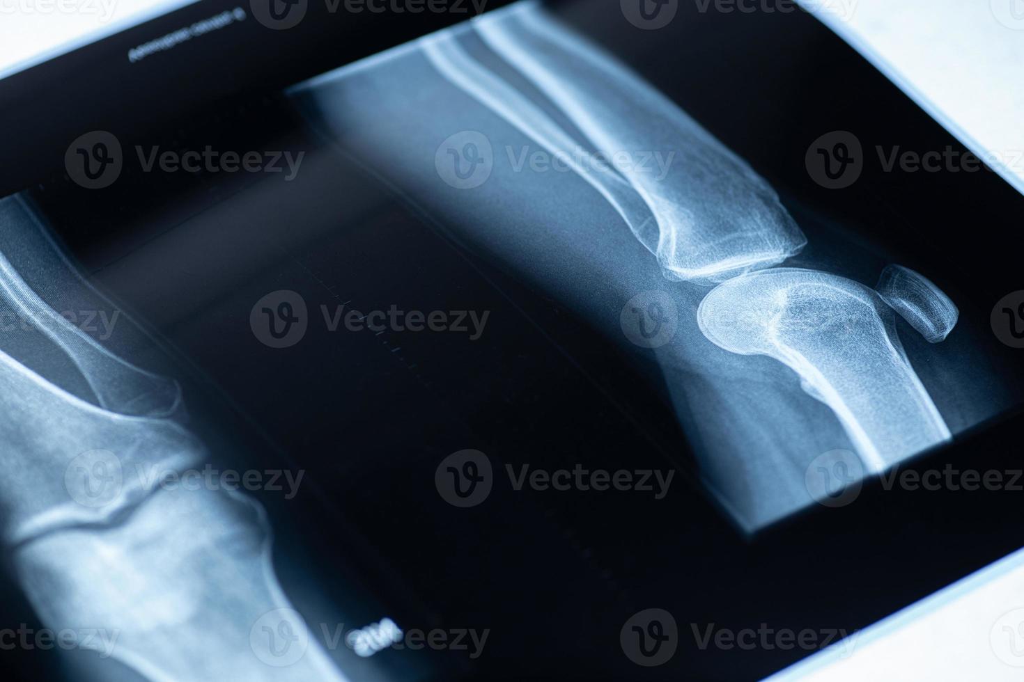 radiografía de la rodilla humana. problemas con los huesos o las articulaciones. foto