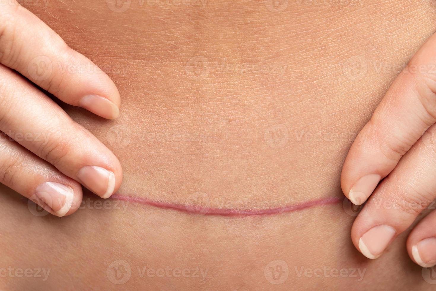 Scar after C-Section surgery on female belly photo