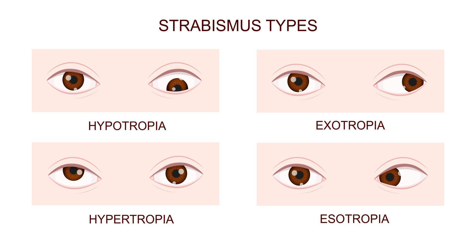 Strabismus types. Hypotropia, hypertropia, exotropia, esotropia. Human eyes with different squint disorders. Crossed eyes condition vector