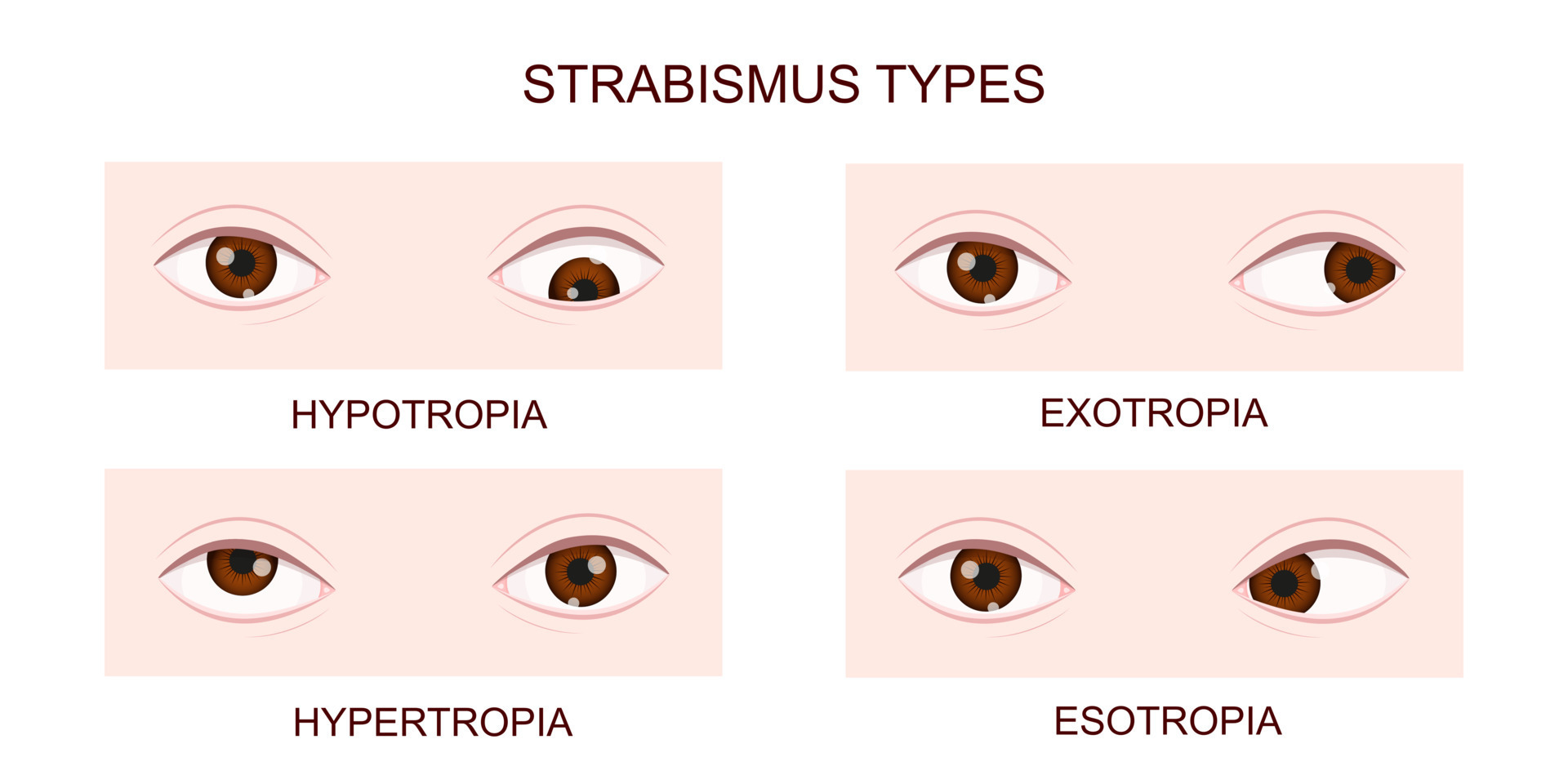 Strabismus types. Hypotropia, hypertropia, exotropia, esotropia. Human