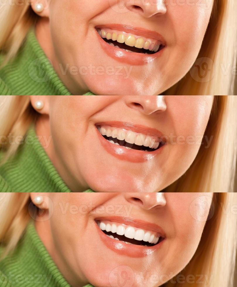 Smiling female showing progressive teeth whitening and bleaching. photo