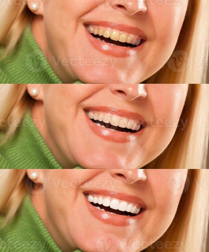 mujer sonriente que muestra blanqueamiento y blanqueamiento dental progresivo. foto