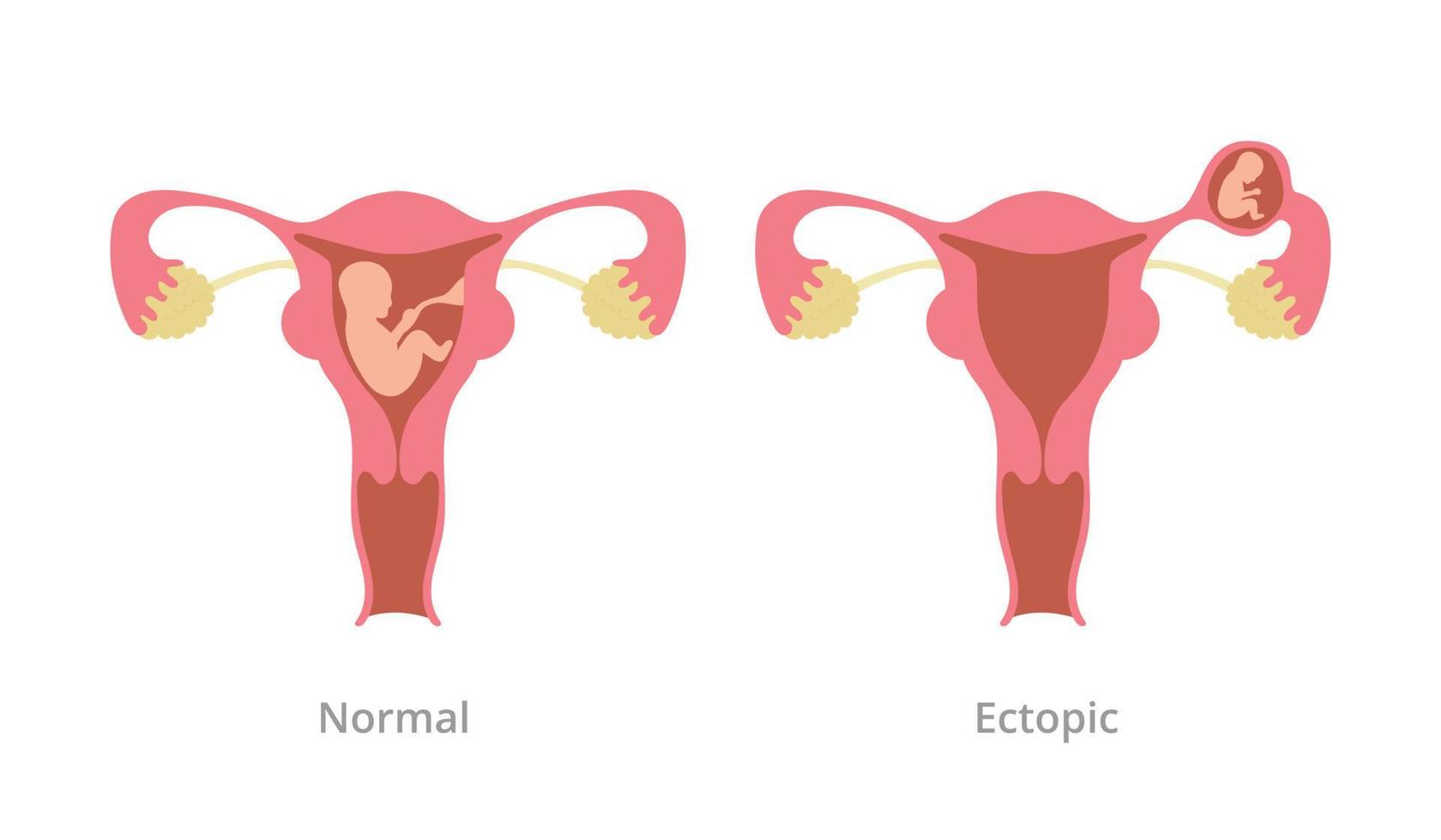 ectopic pregnancy pregnancy problem with comparison with normal pregnancy with modern flat style vector