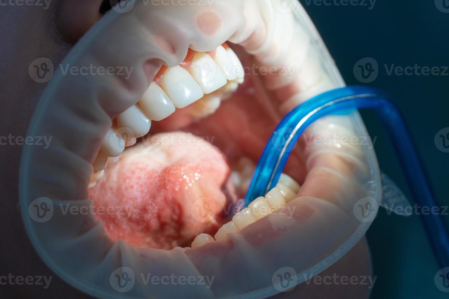 close up of girl's teeth at dental clinic photo
