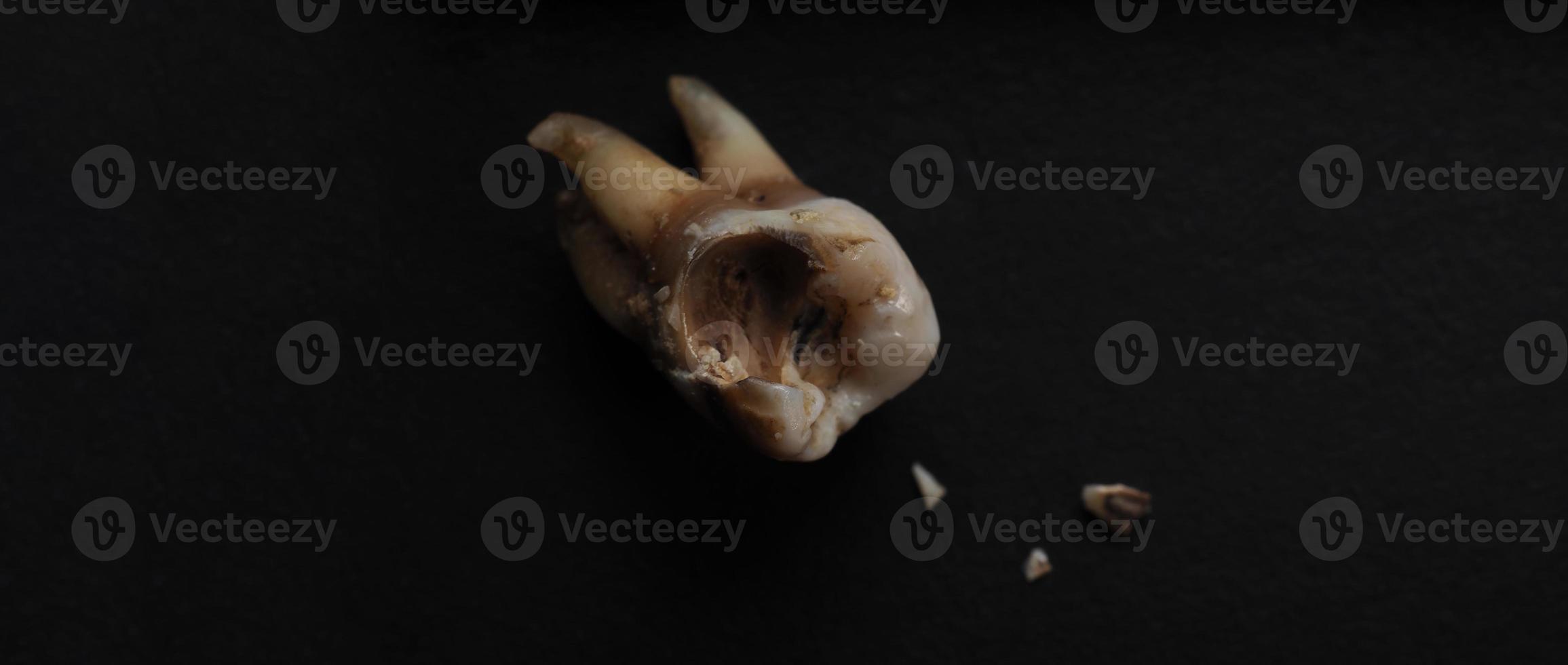 Macro shot of a decayed teeth till root after extraction of dentist. photo