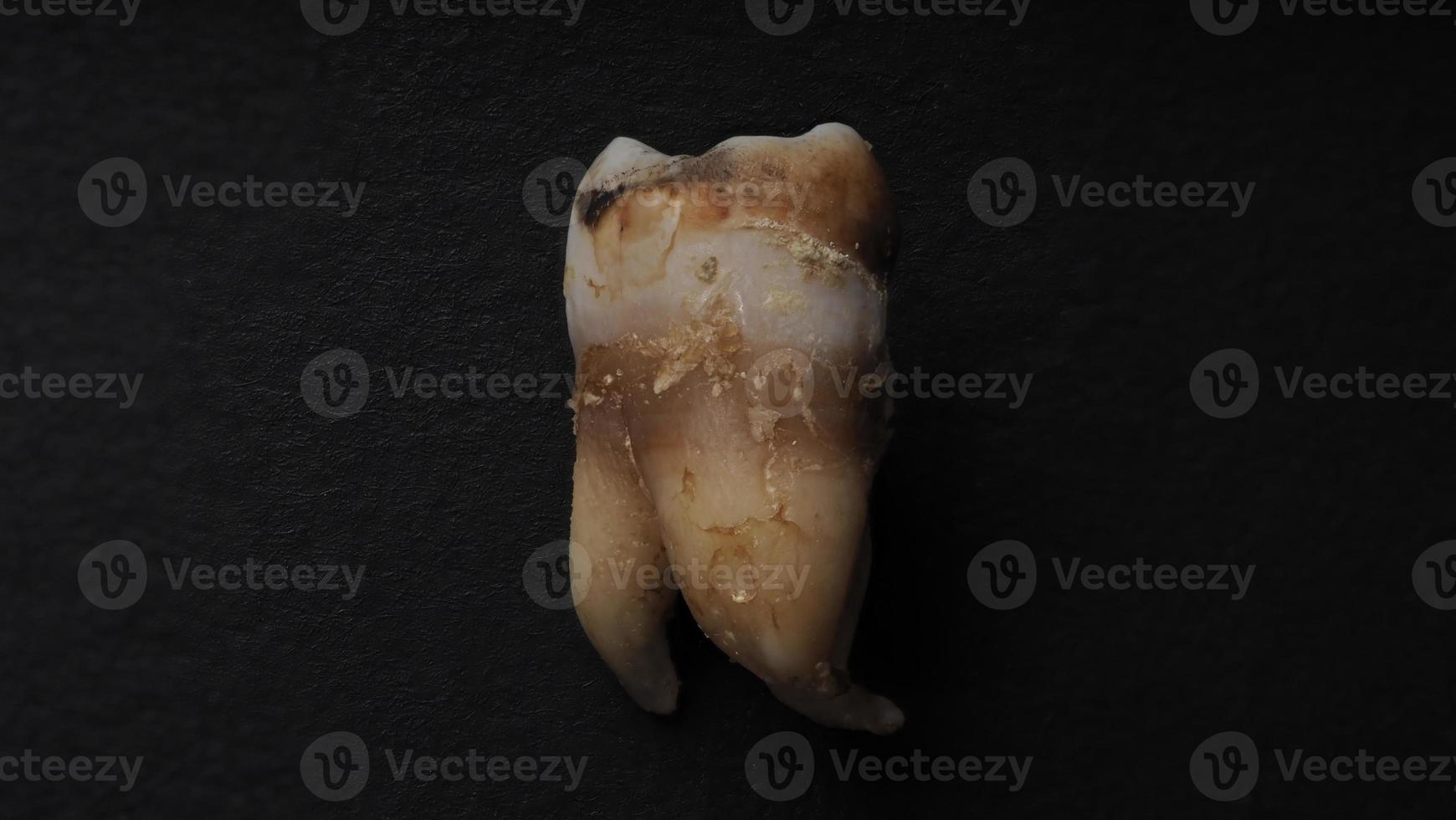 toma macro de dientes cariados hasta la raíz después de la extracción del dentista. foto