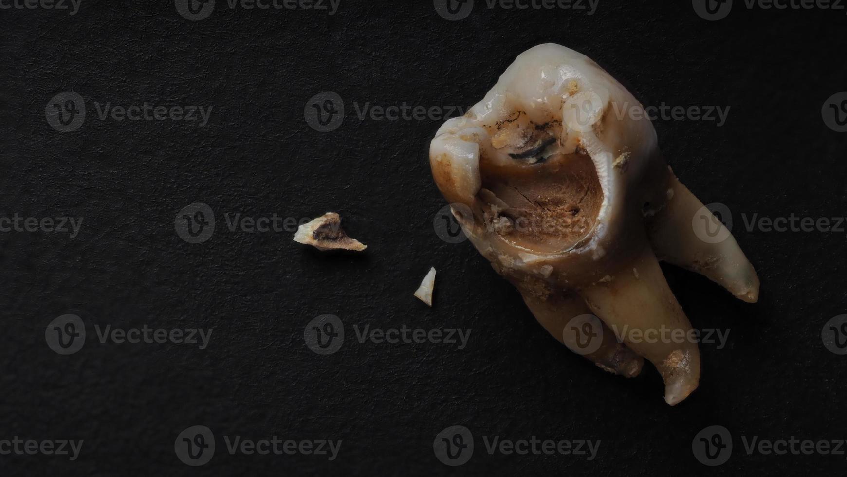 toma macro de dientes cariados hasta la raíz después de la extracción del dentista. foto