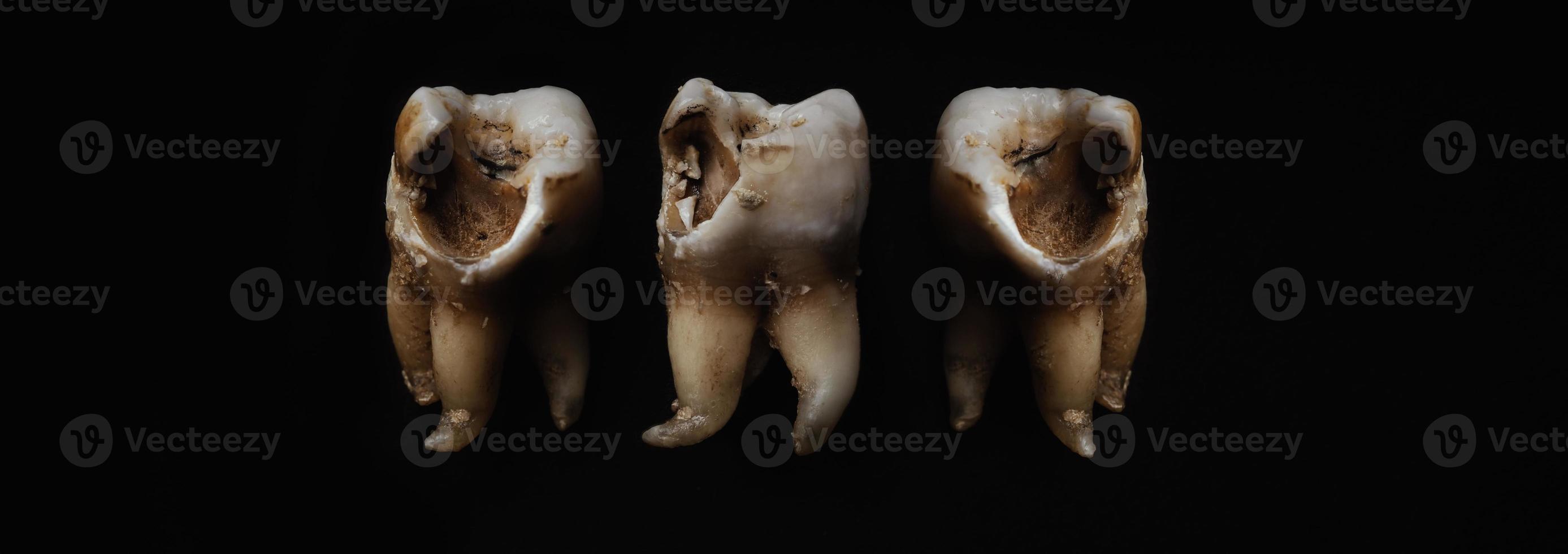 Macro shot of a decayed teeth till root after extraction of dentist. photo