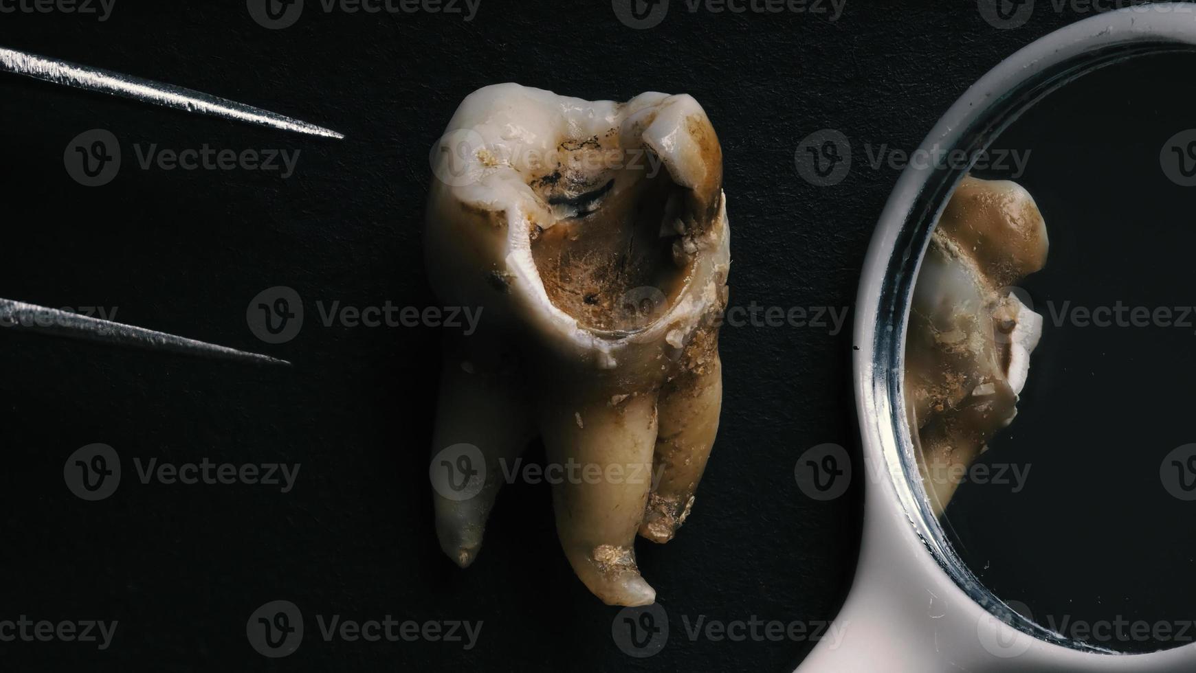 toma macro de dientes cariados hasta la raíz después de la extracción del dentista. foto