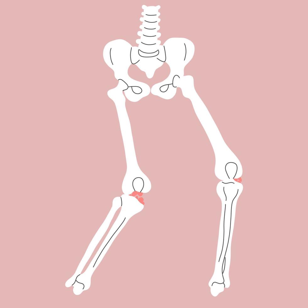 anterior cruciate ligament Injuries vector