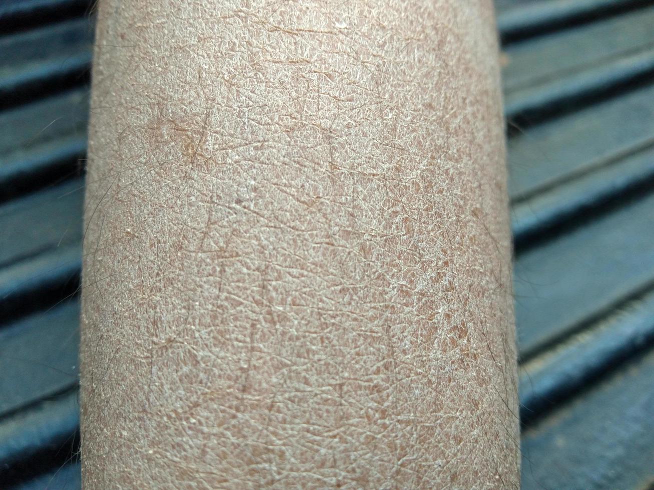 dry cracked skin concept  Dermatitis, eczema, ringworm  cream lotion cosmetic photo