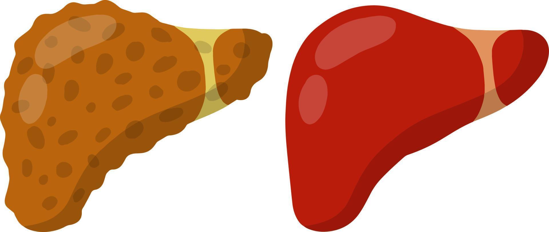 Healthy and diseased liver. Medical element. Biology and education. Health problem. Comparison of two internal organs of a person vector