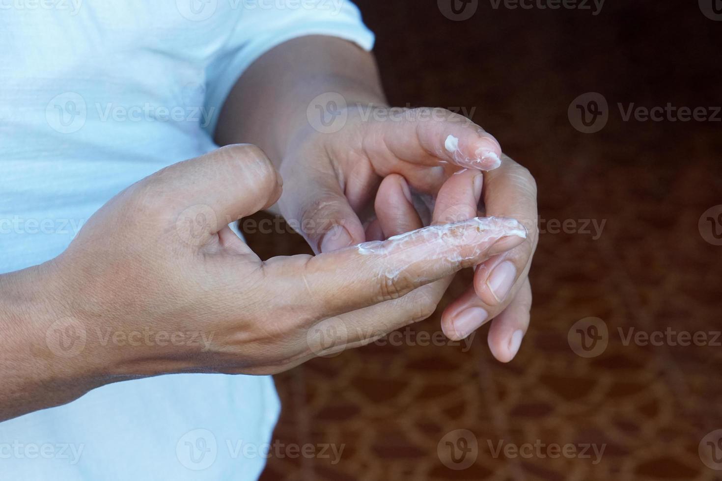 Closeup hand applying medicinal cream on infectious fingers. Concept, dermatitis treatment. Fingers with fungal, bacterial or inflammatory. Healthcare and heath problems. photo