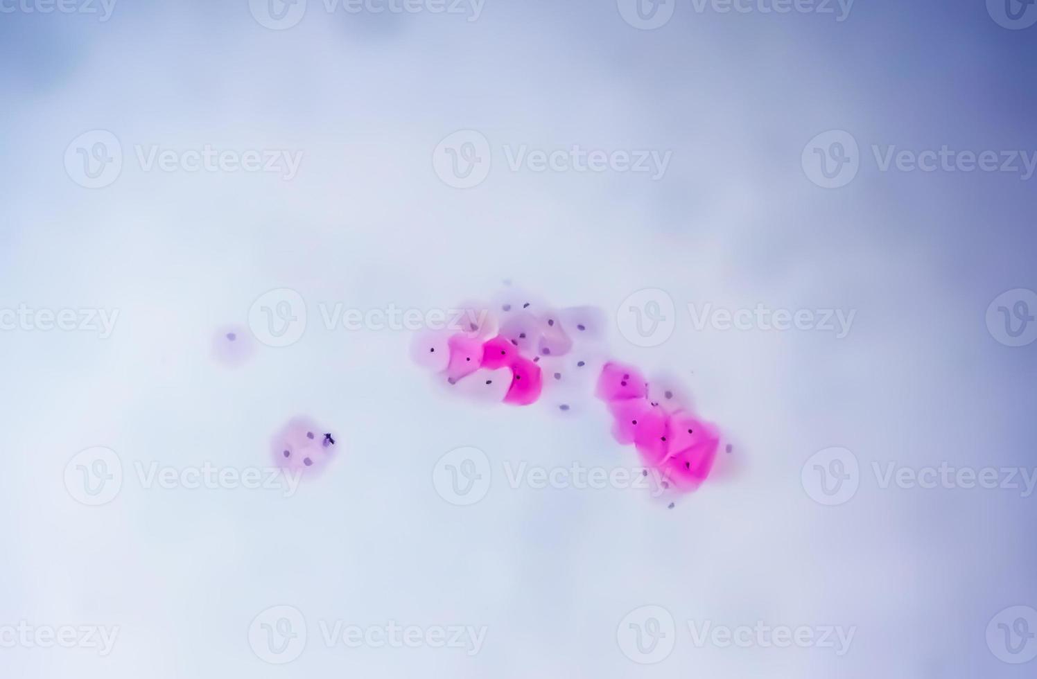 Paps smear under microscopy showing inflammatory smear with hpv related changes. Cervical cancer. SCC photo